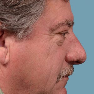 rhinoplasty rhinophyma