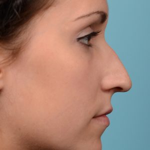 Rhinoplasty Hump removal and straightening