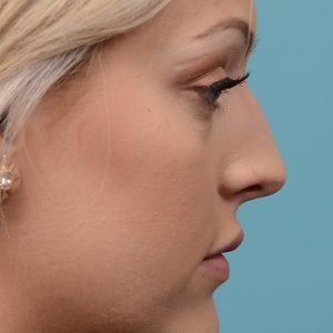 Hump removal and de-projection