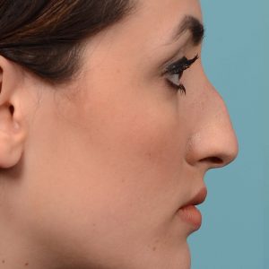 Bump removal rhinoplasty on female