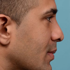 Male nose reduction surgery