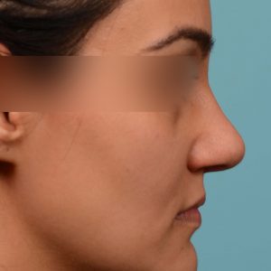 Rhinoplasty before and after