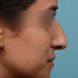 Rhinoplasty hump reduction