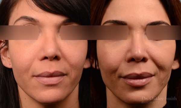 This woman had rhinoplasty to reduce the overall size of her nose. the result is more feminine