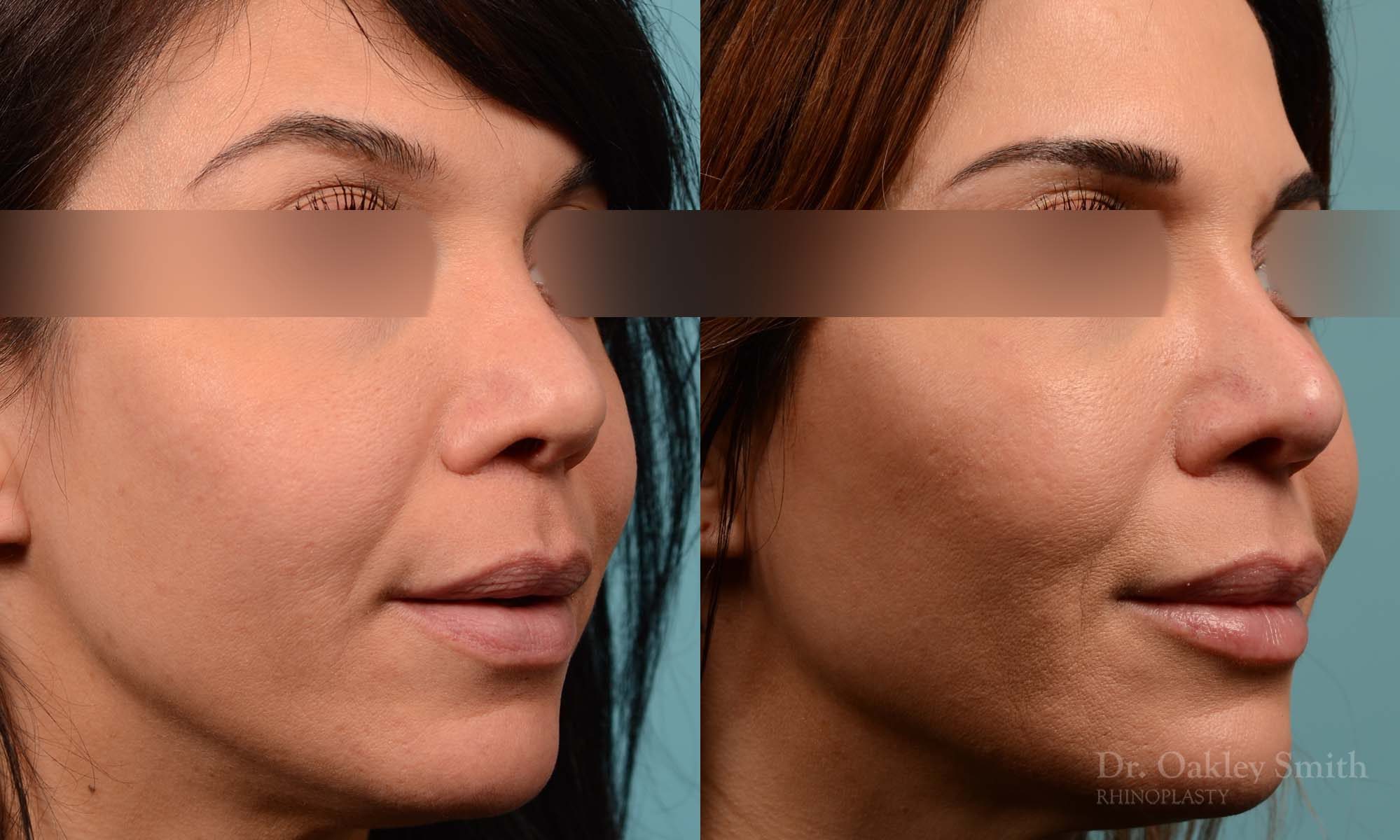 This woman had rhinoplasty to reduce the overall size of her nose. the result is more feminine