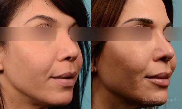 This woman had rhinoplasty to reduce the overall size of her nose. the result is more feminine