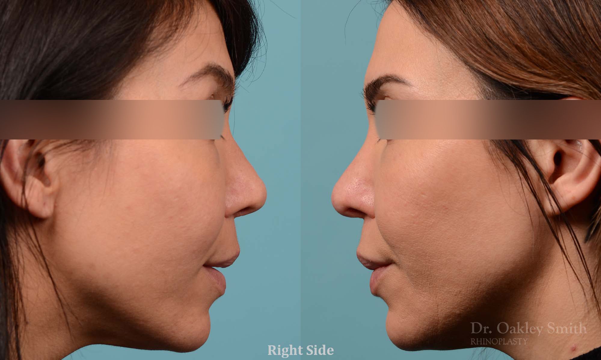 This woman had rhinoplasty to reduce the overall size of her nose. the result is more feminine