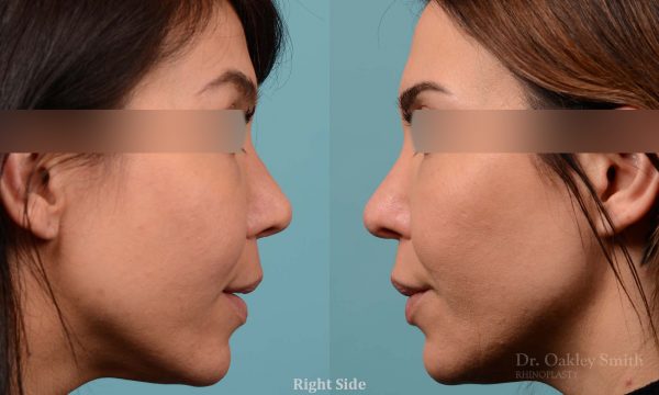 Female rhinoplasty to reduce the curvature on her nose
