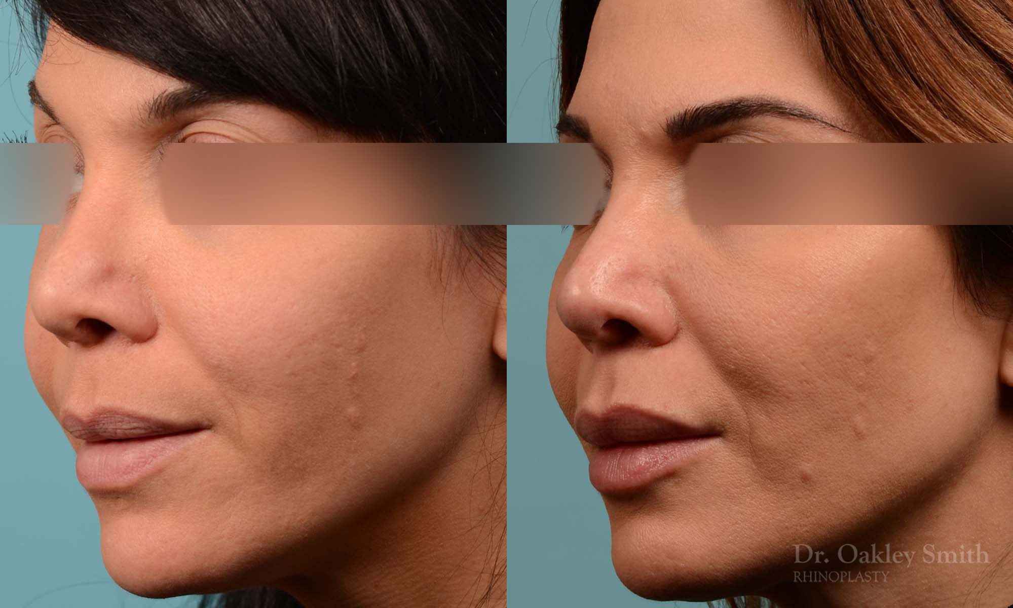 This woman had rhinoplasty to reduce the overall size of her nose. the result is more feminine