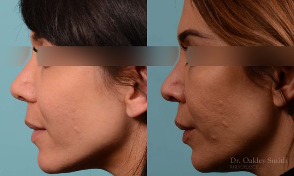 This woman had rhinoplasty to reduce the overall size of her nose. the result is more feminine