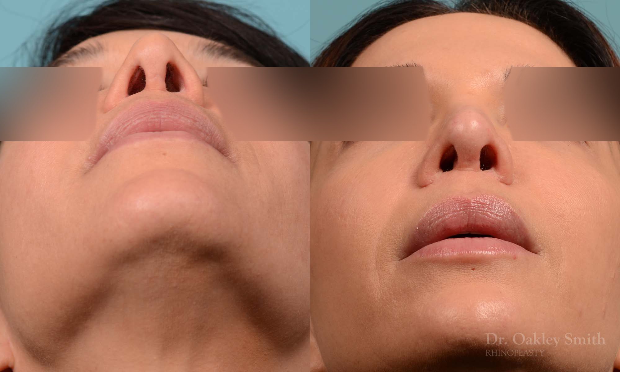This woman had rhinoplasty to reduce the overall size of her nose. the result is more feminine