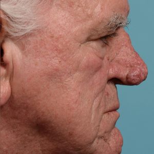 Rhinophyma gentleman
