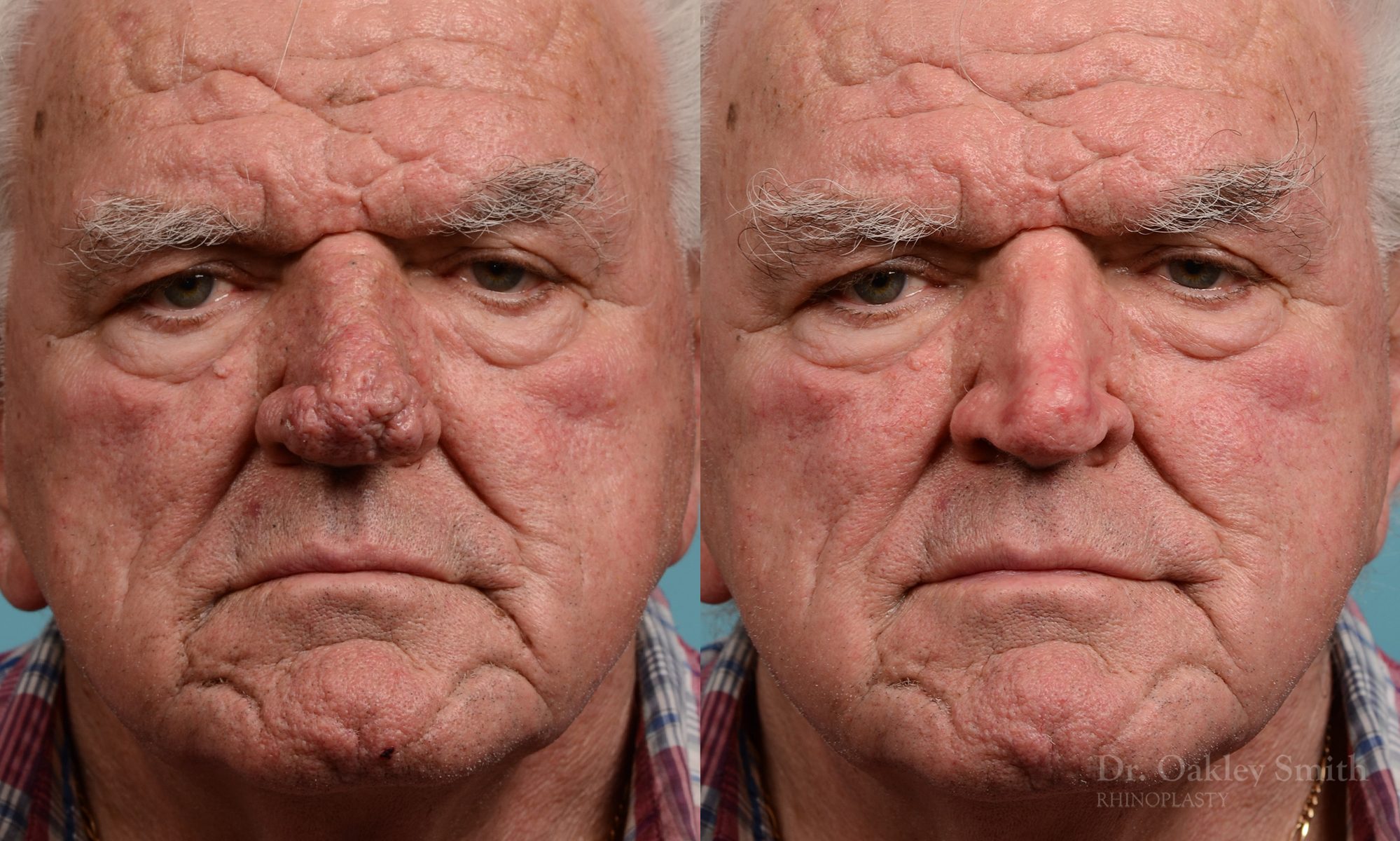 Rhinophyma gentleman