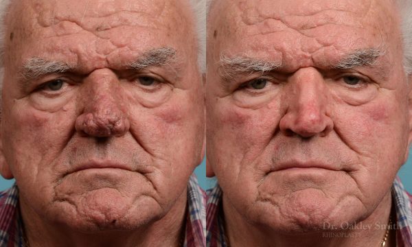Rhinophyma gentleman