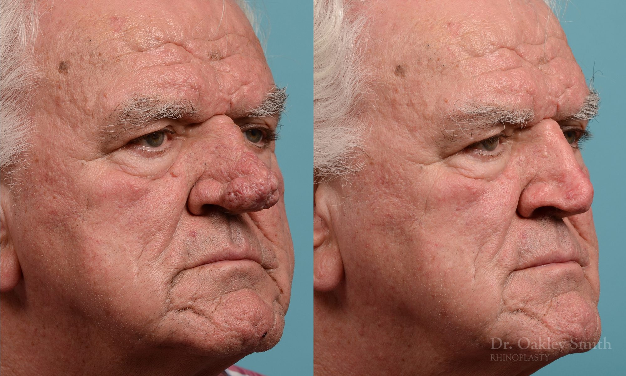 Rhinophyma gentleman