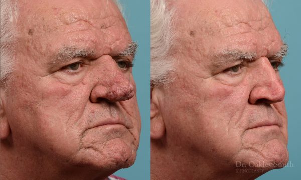 Rhinophyma gentleman