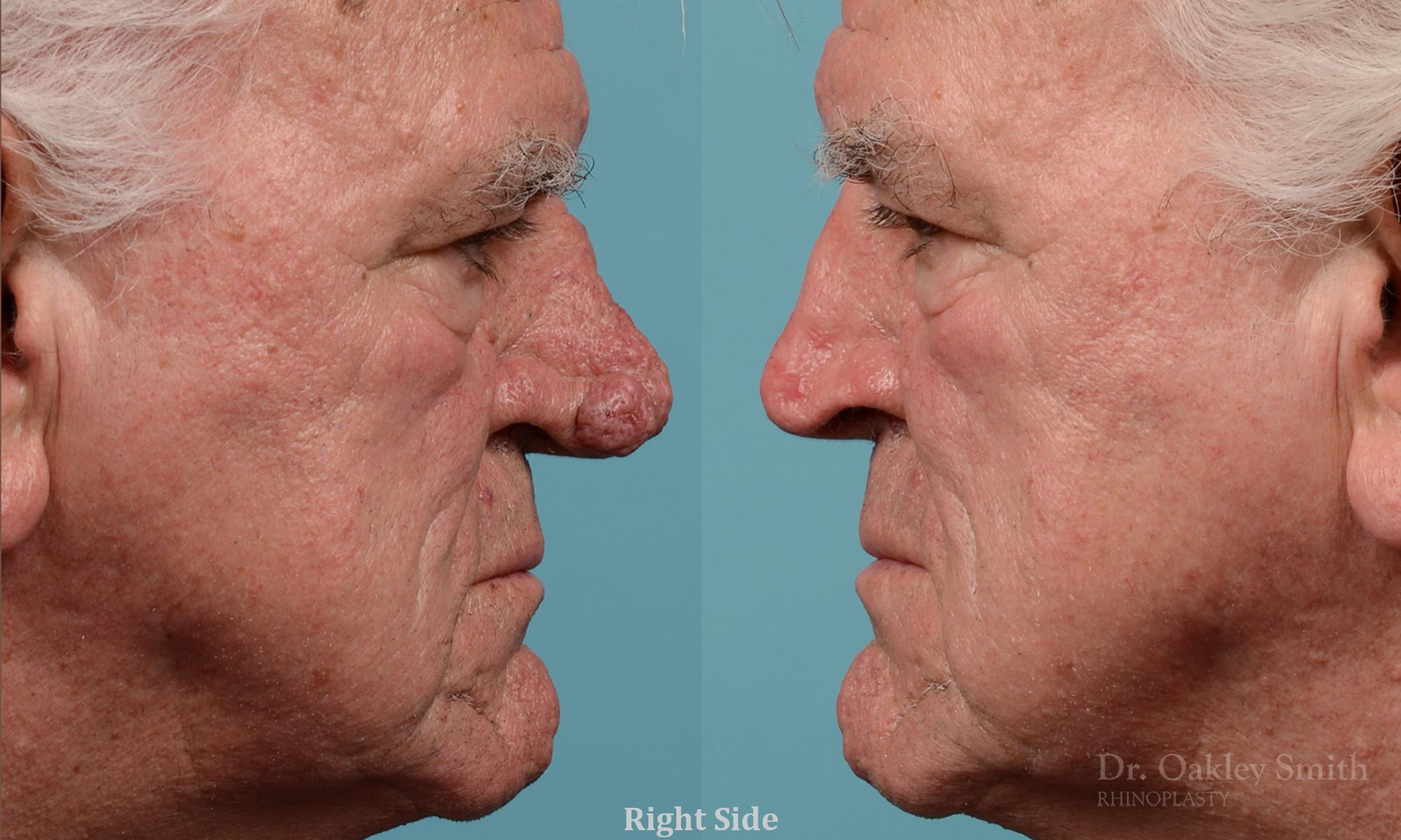 Rhinophyma gentleman