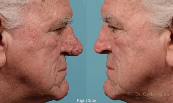 Rhinophyma gentleman