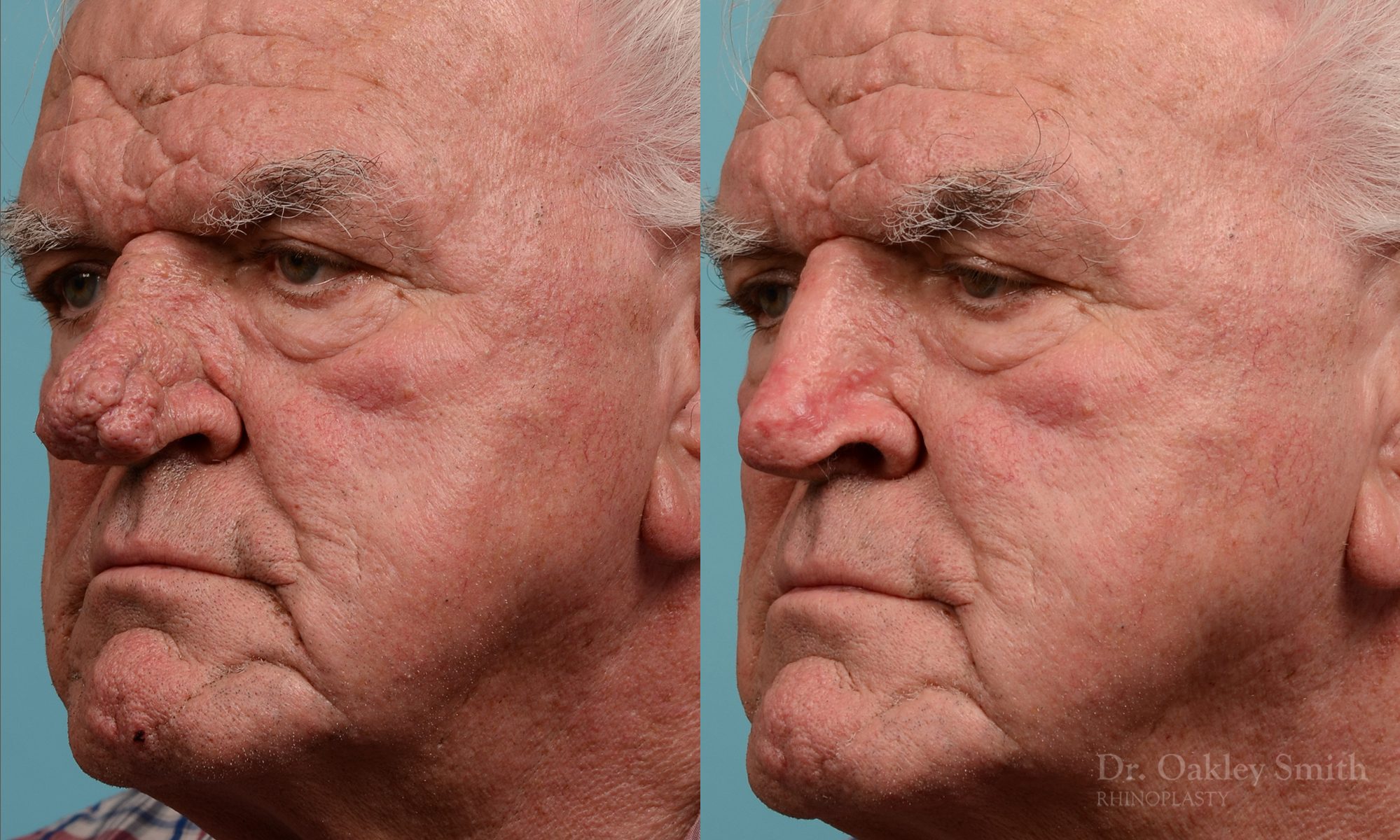 Rhinophyma gentleman