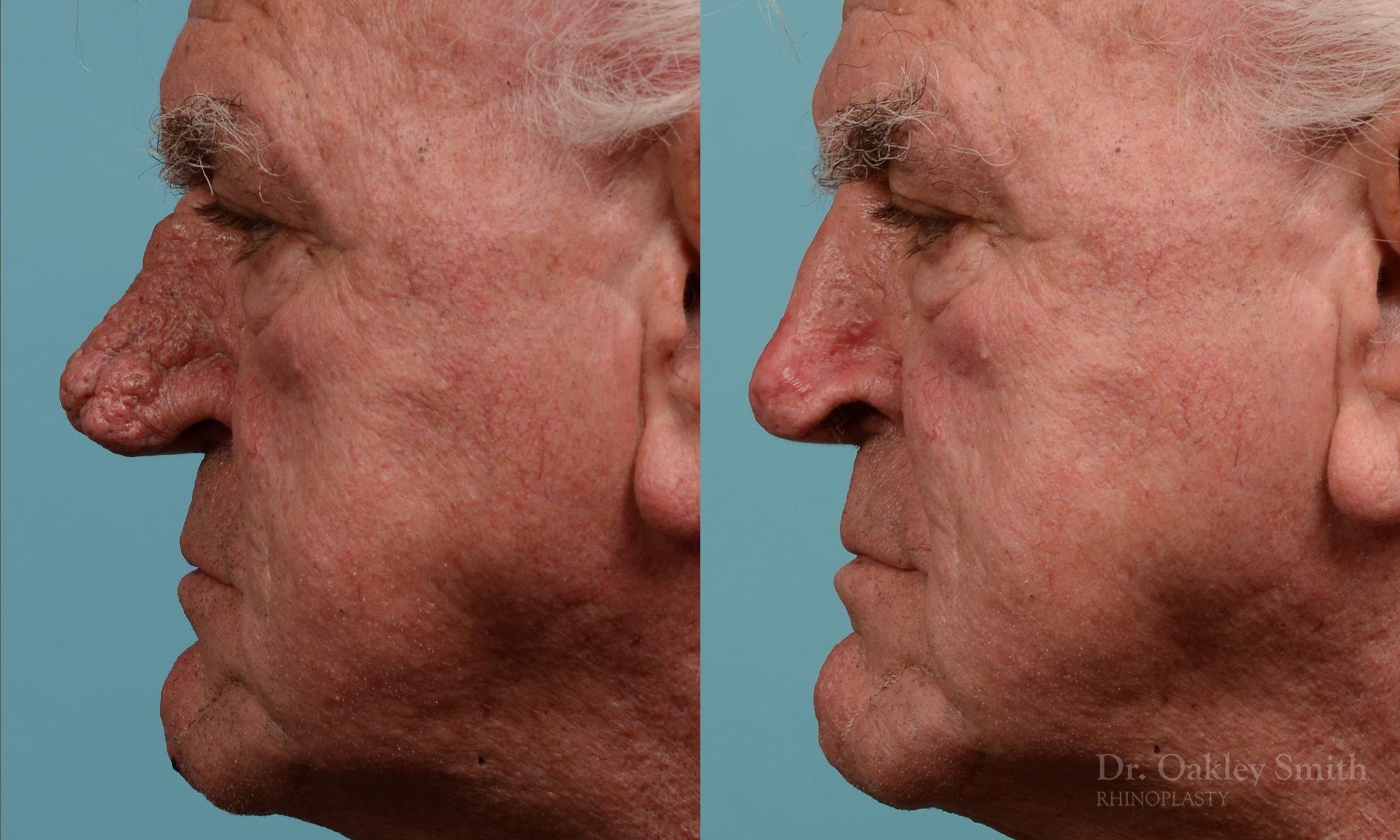 Rhinophyma gentleman