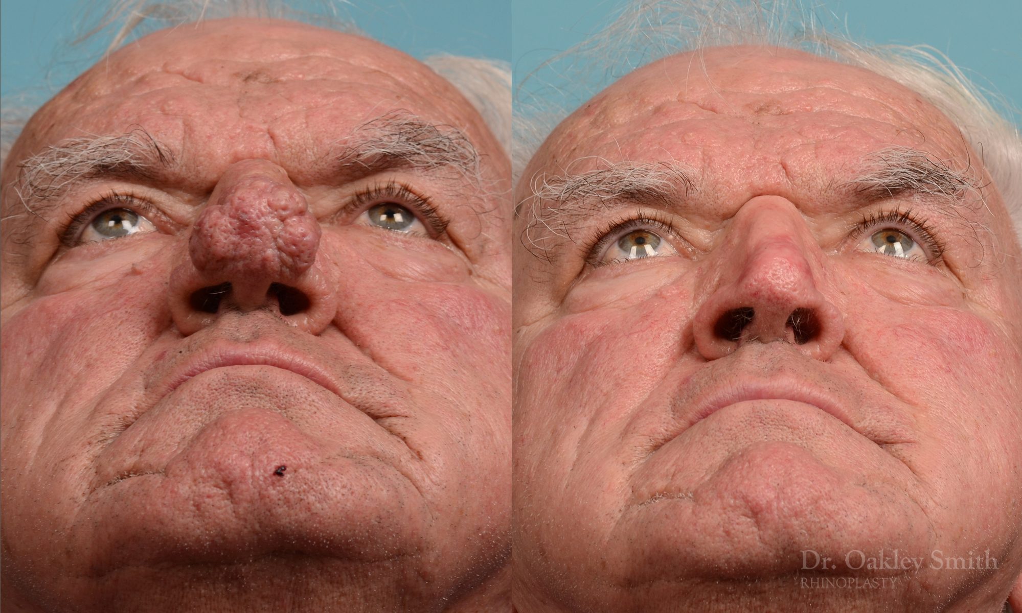 Rhinophyma gentleman