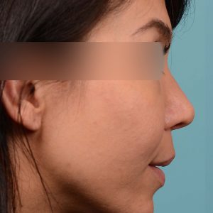 Rhinoplasty narrowed nose
