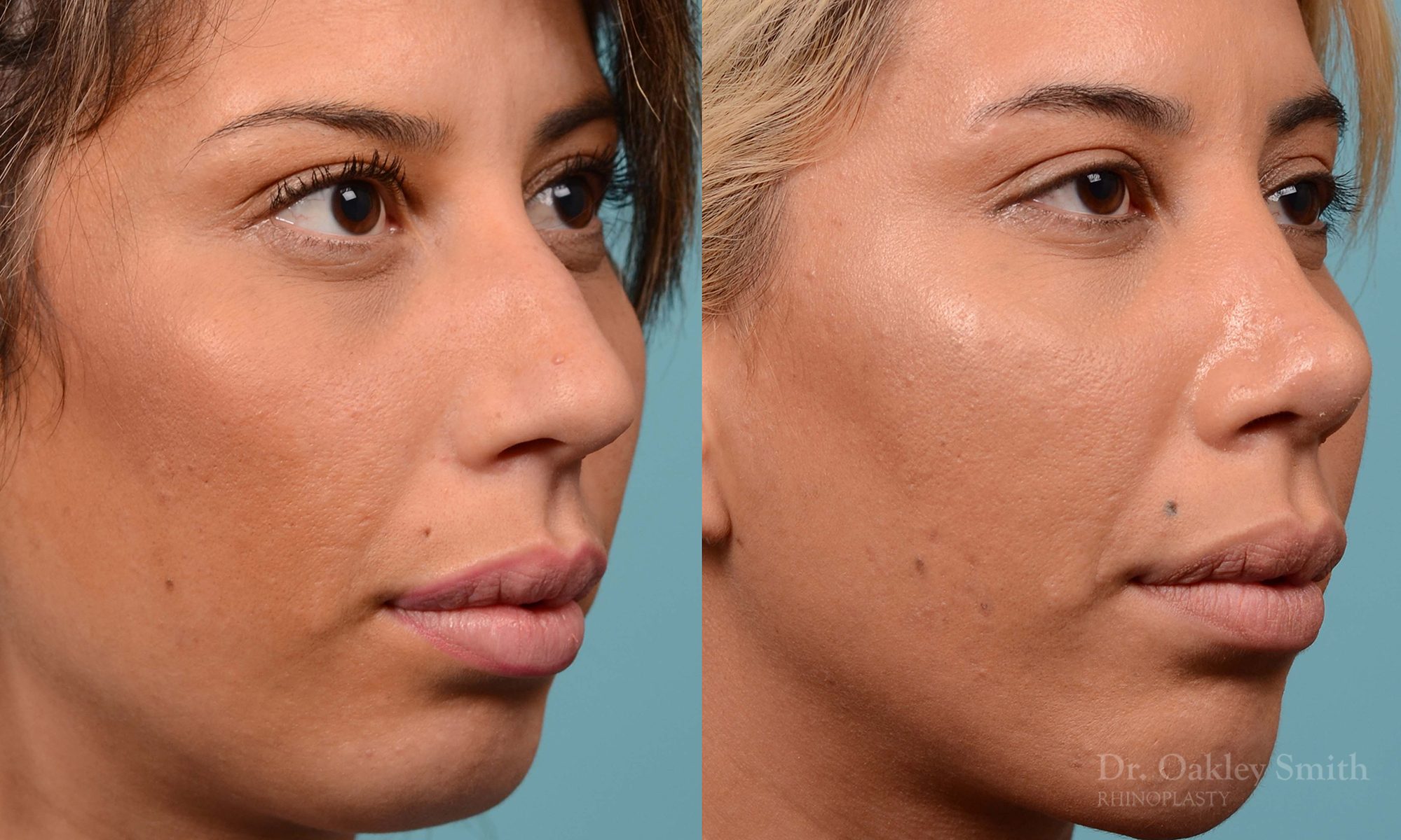 Rhinoplasty hump reduction