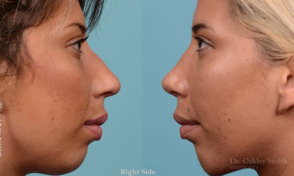 Rhinoplasty hump reduction