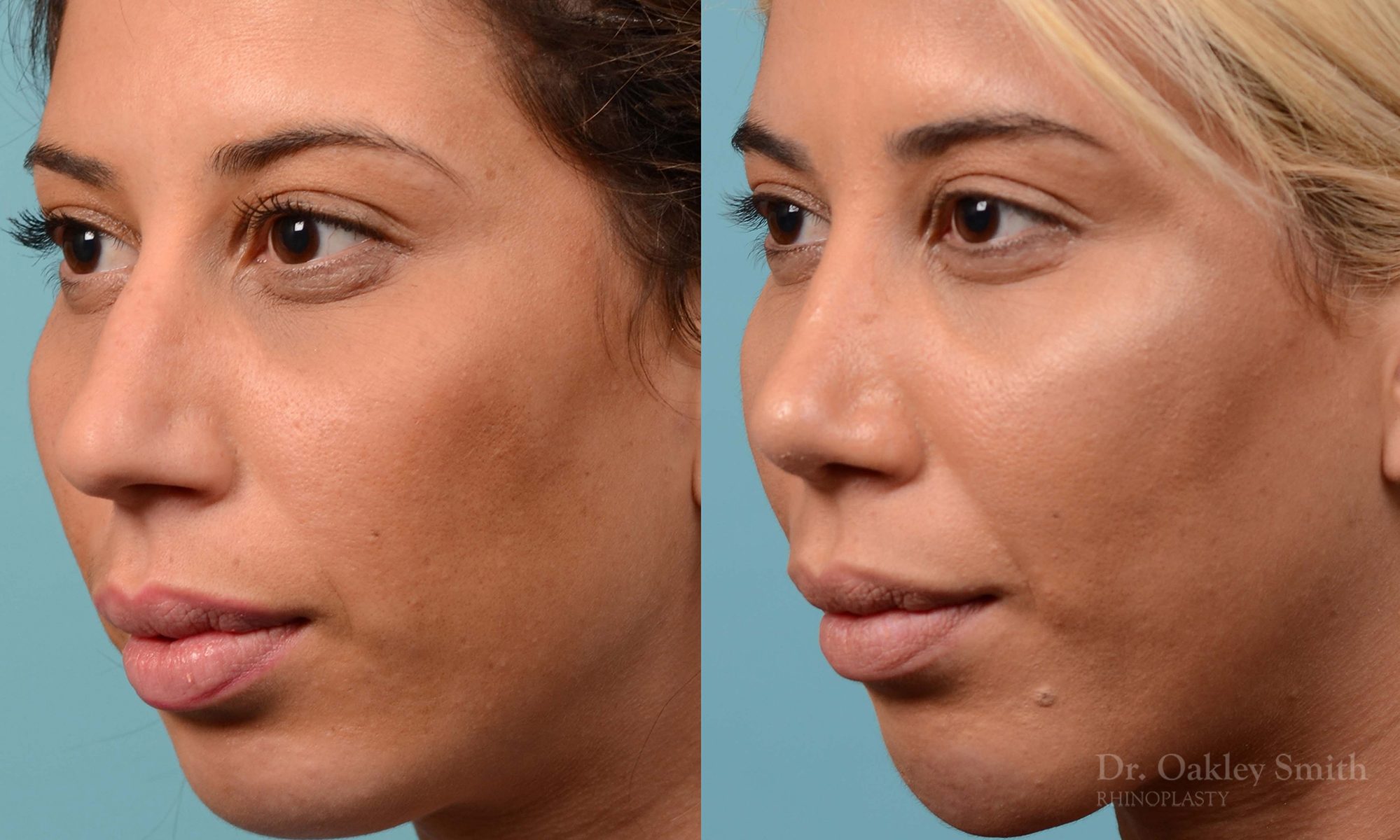 Rhinoplasty hump reduction