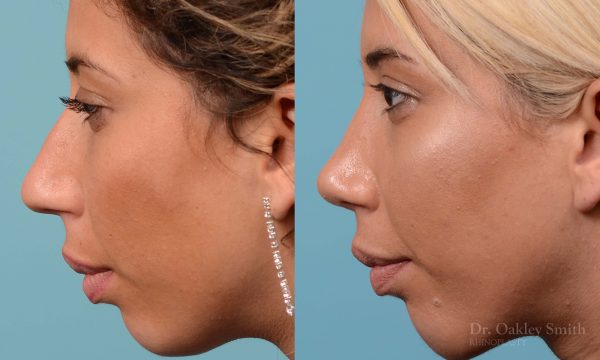 Rhinoplasty hump reduction