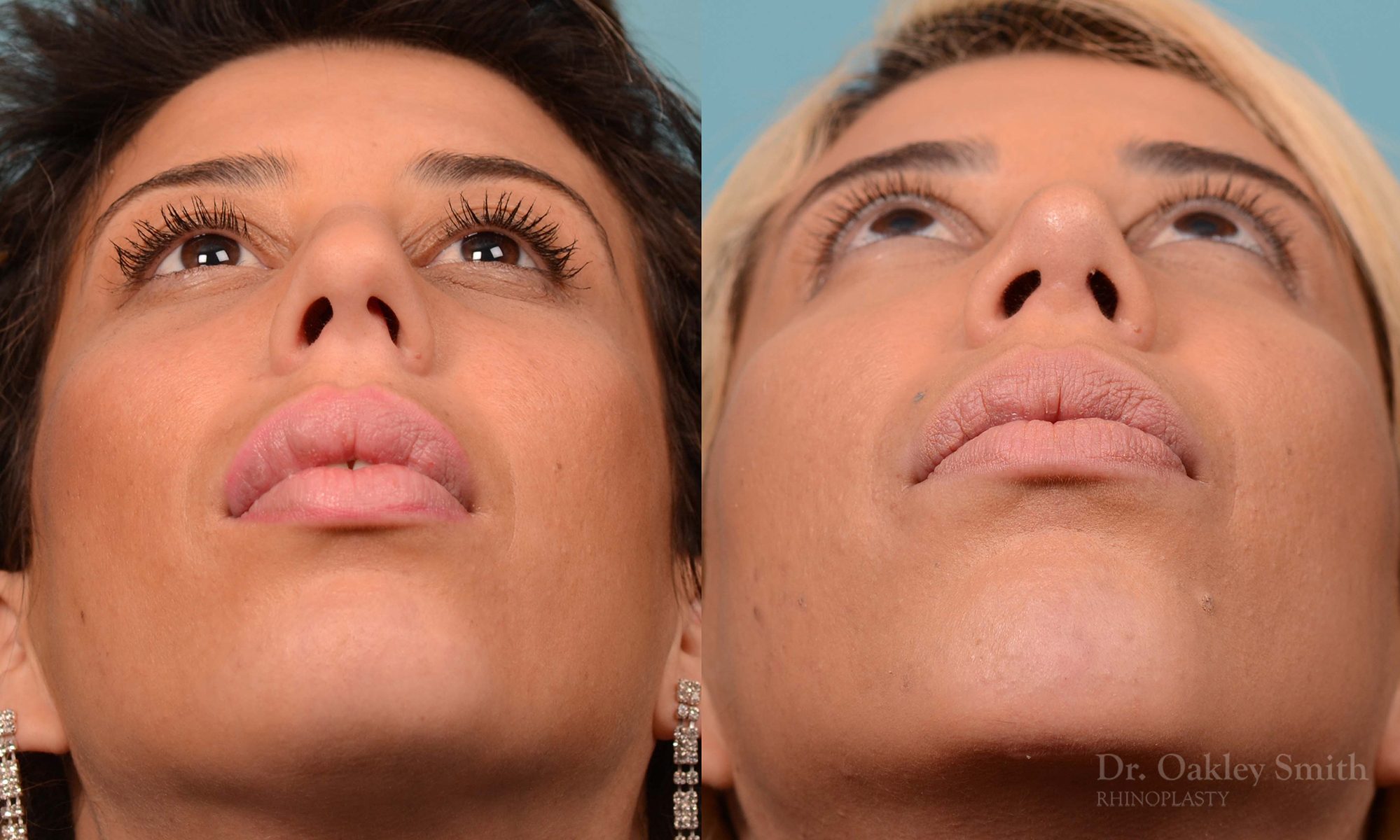 Rhinoplasty hump reduction