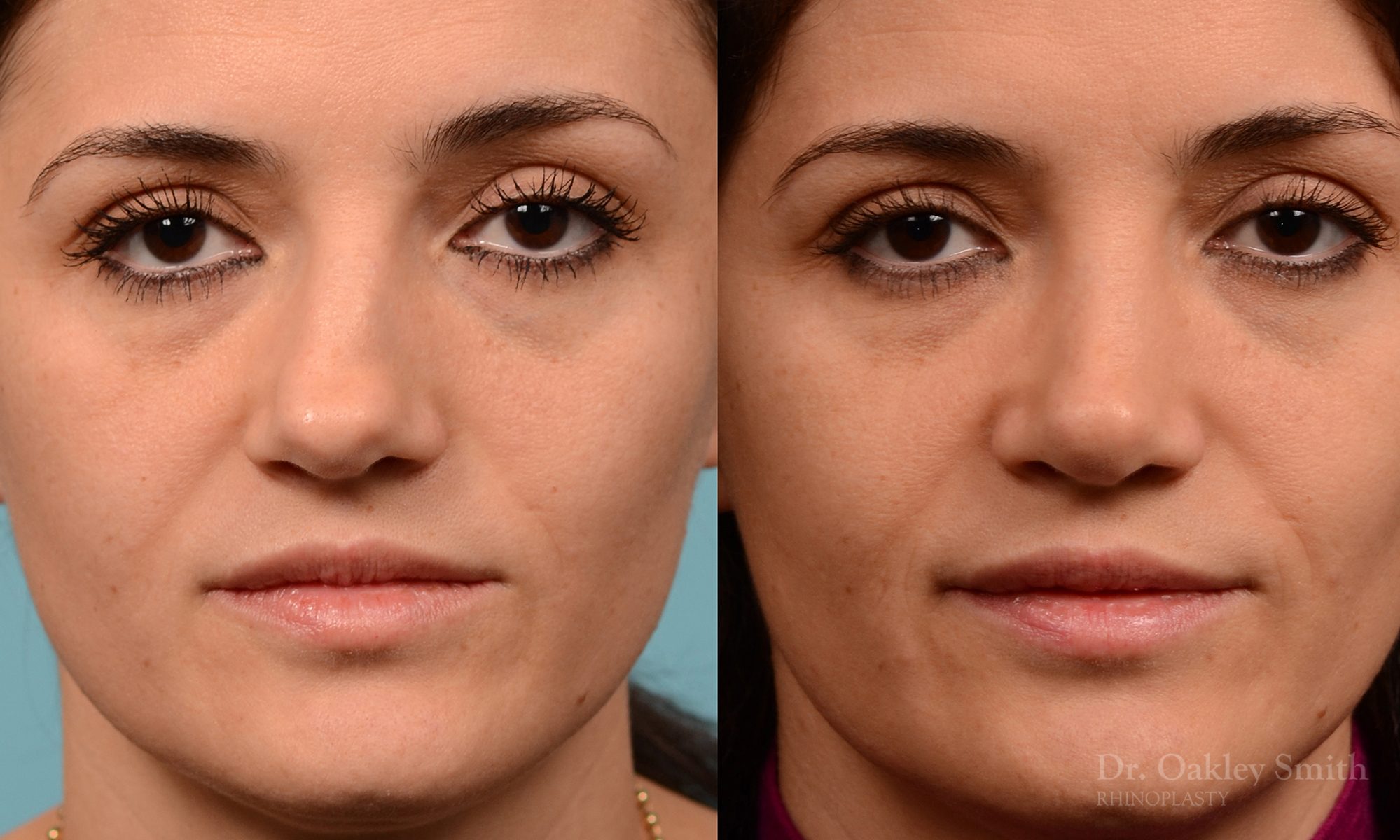 Rhinoplasty curved nose