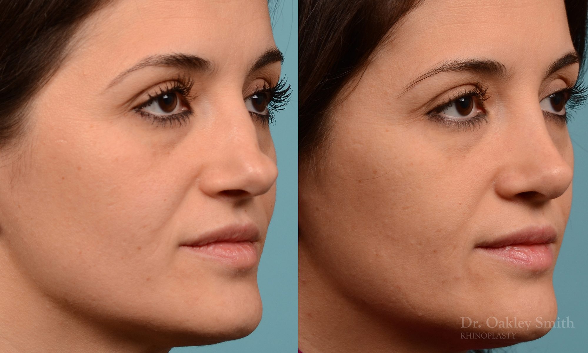 Rhinoplasty curved nose