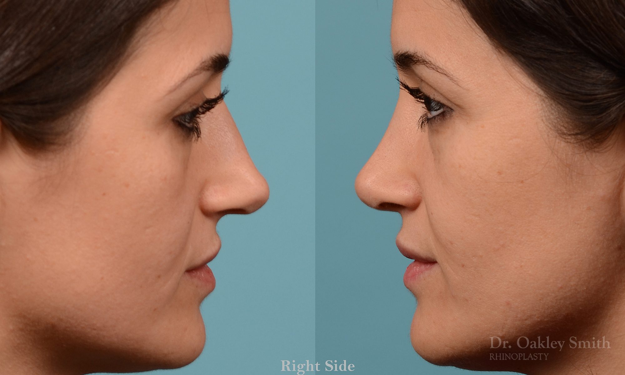 Rhinoplasty curved nose