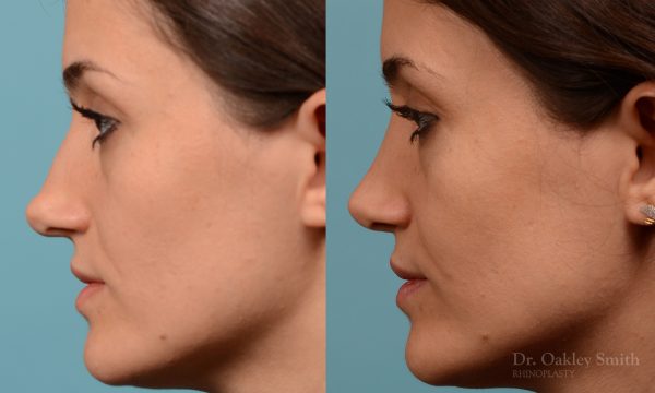 Rhinoplasty curved nose