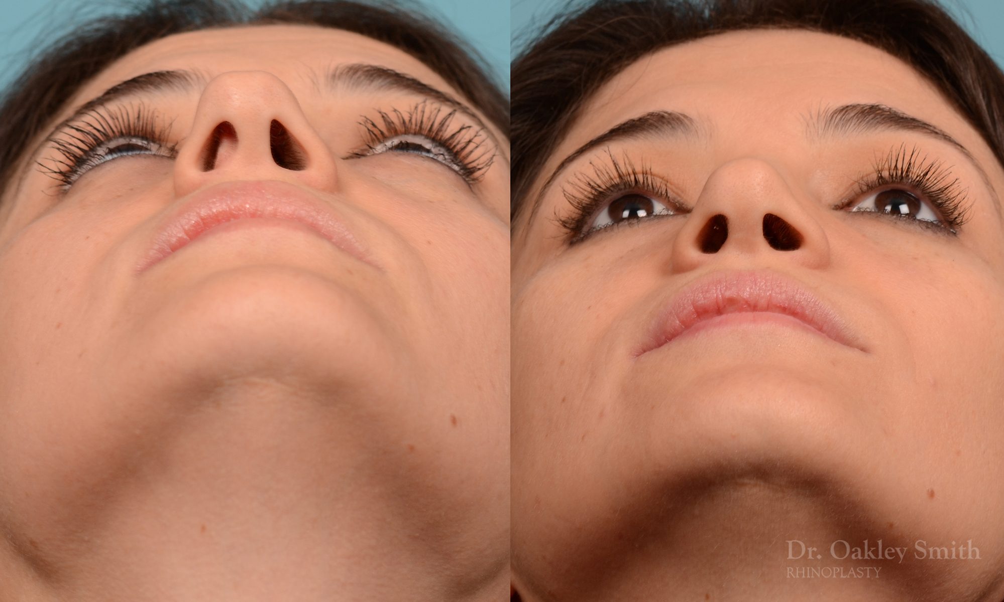 Rhinoplasty curved nose