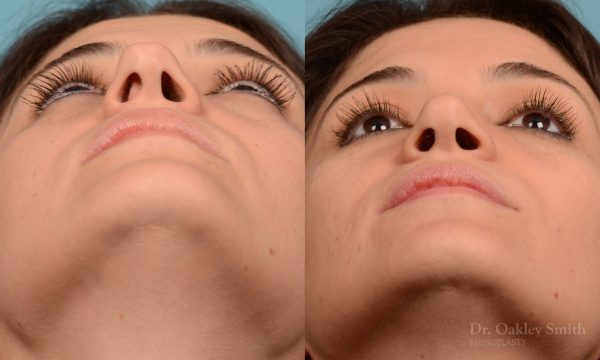 Rhinoplasty curved nose