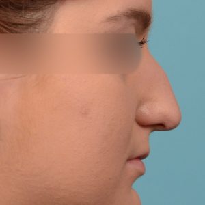 Rhinoplasty - Rhinoplasty Before and After Case 235