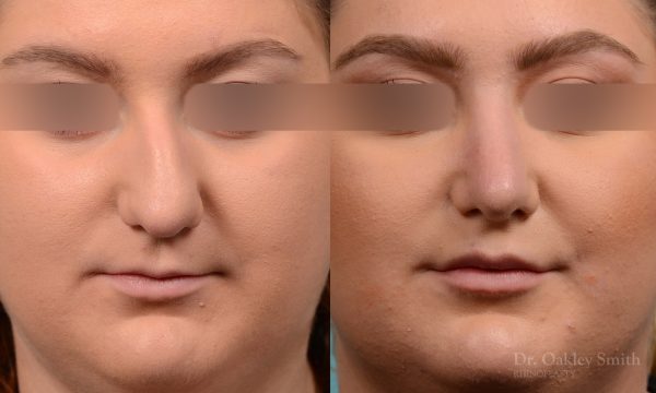 Curved nose rhinoplasty