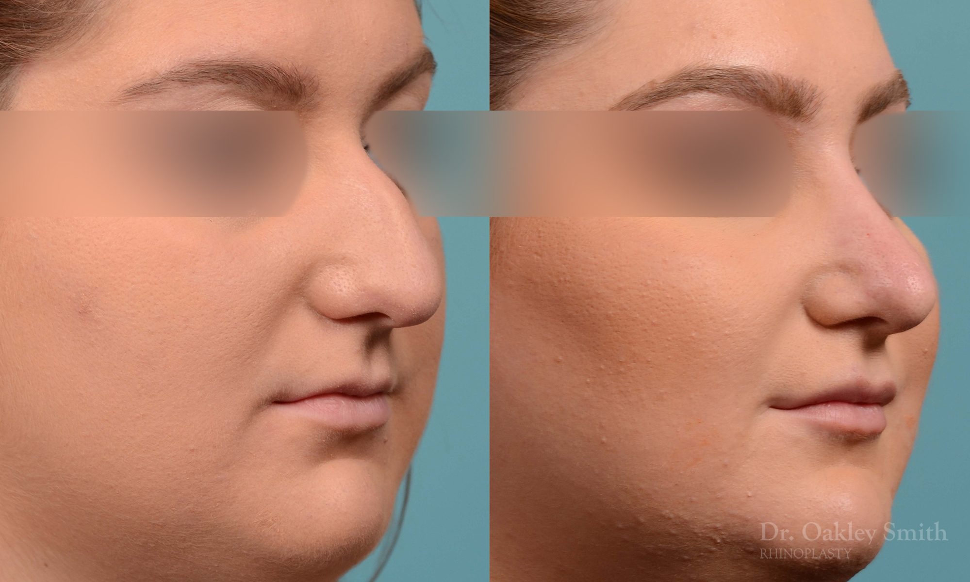 Curved nose rhinoplasty