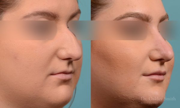 Curved nose rhinoplasty