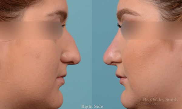 Curved nose rhinoplasty