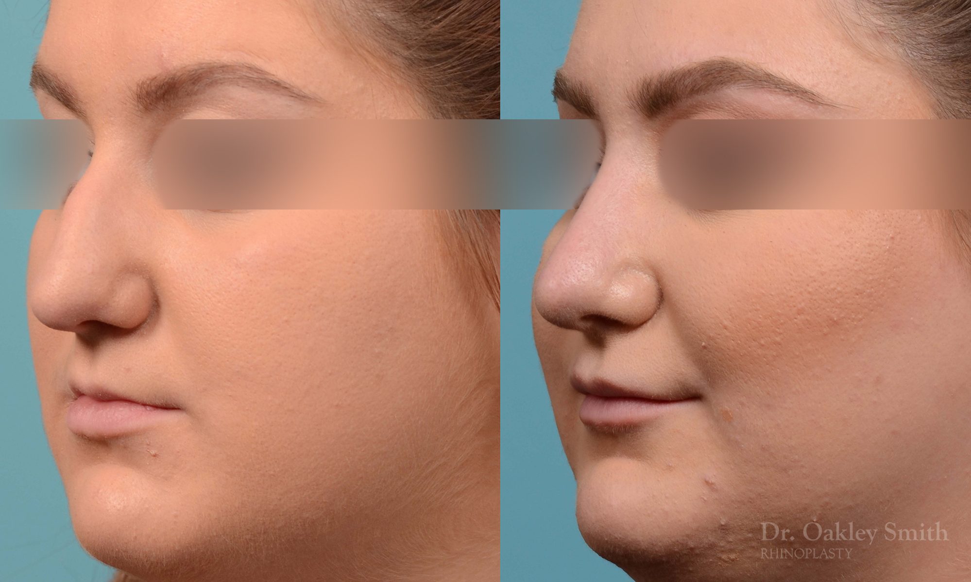 Curved nose rhinoplasty