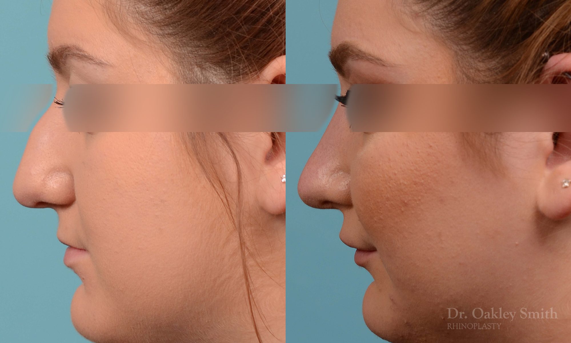 Curved nose rhinoplasty
