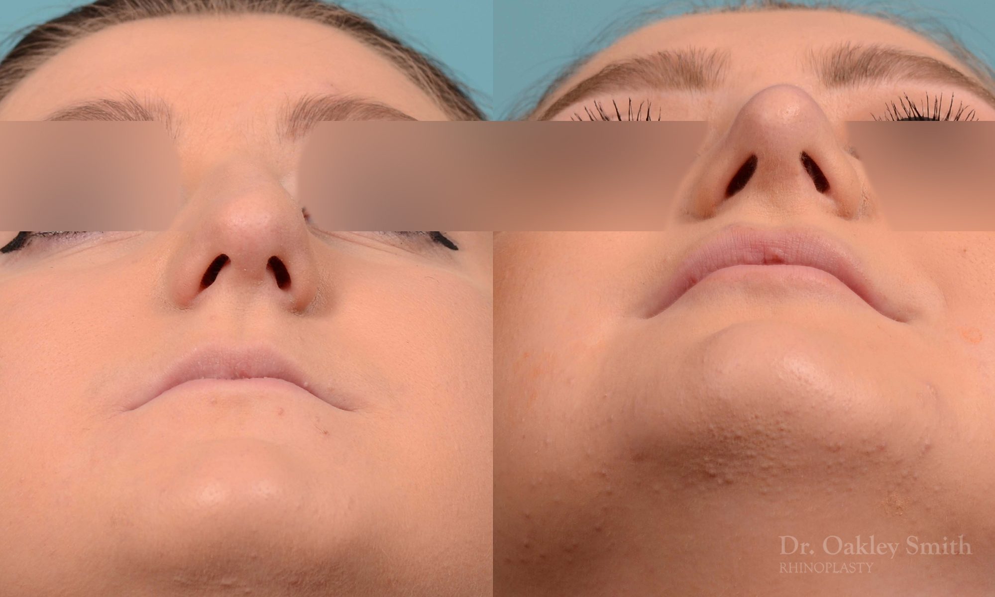 Curved nose rhinoplasty