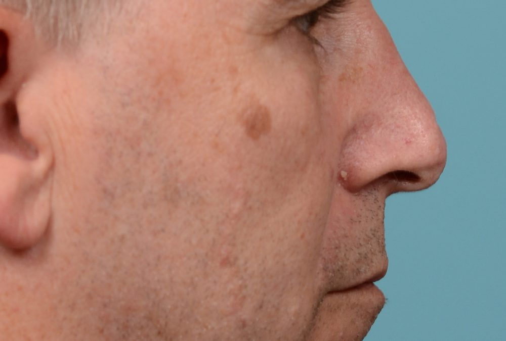 Scar Removal Before and After Case 240