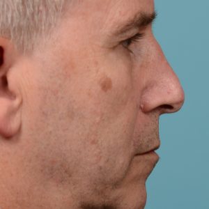 scar removal from previous surgery