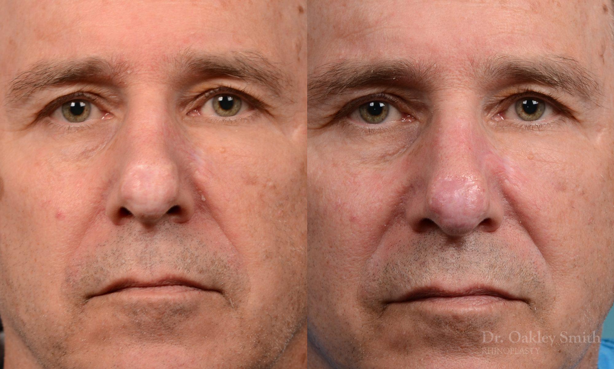 scar removal from previous surgery