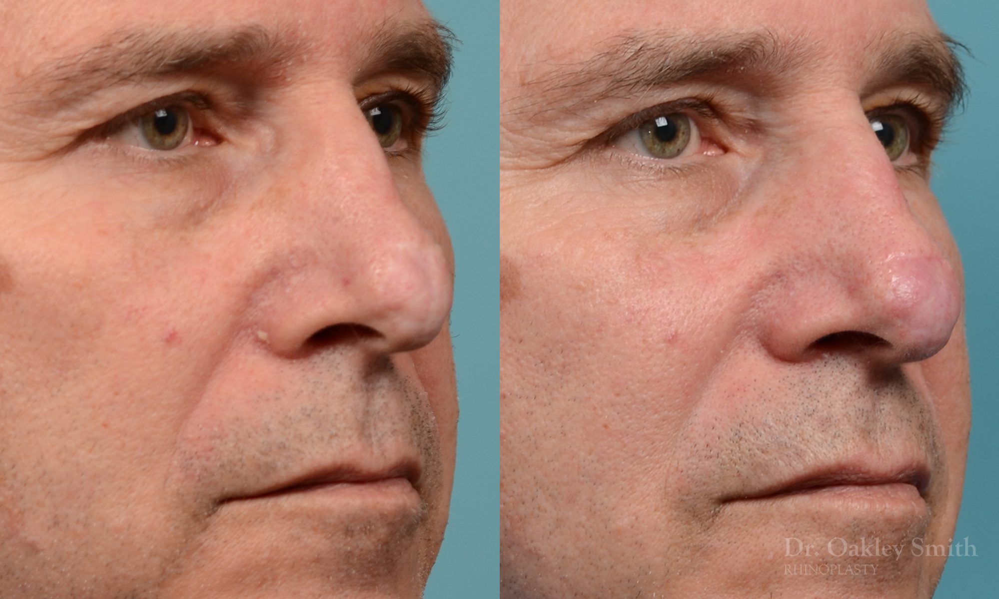 scar removal from previous surgery