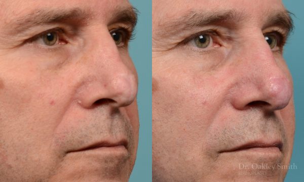 scar removal from previous surgery
